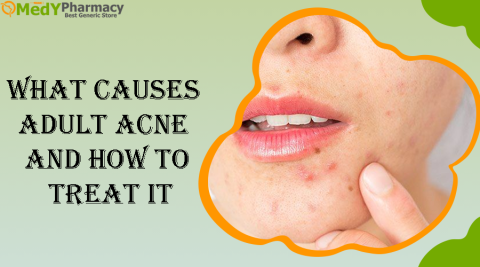 What Causes Adult Acne and How to Treat It