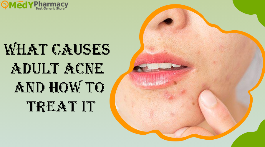 What Causes Adult Acne and How to Treat It