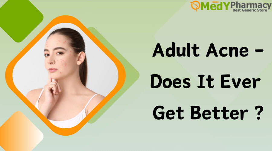 Adult Acne - Does It Ever Get Better?