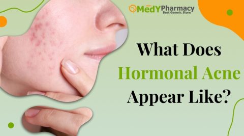 What Does Hormonal Acne Appear Like?